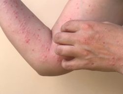 Kasus Monkeypox Bertambah di Indonesia, Kemenkes Akan Lakukan Vaksinasi